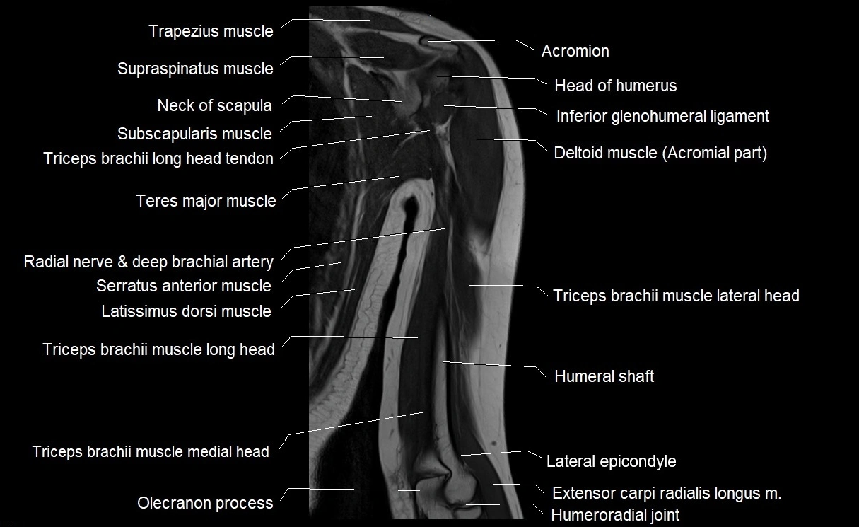 MRI upper arm (humerus ) coronal cross sectional anatomy image 18.webp
